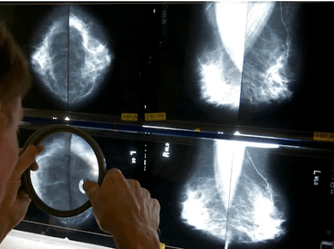 Radiologists examines mammogram image