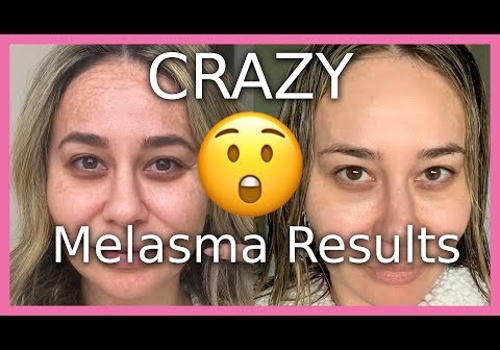 Video Production Package Example: Crazy Before & After Melasma Results